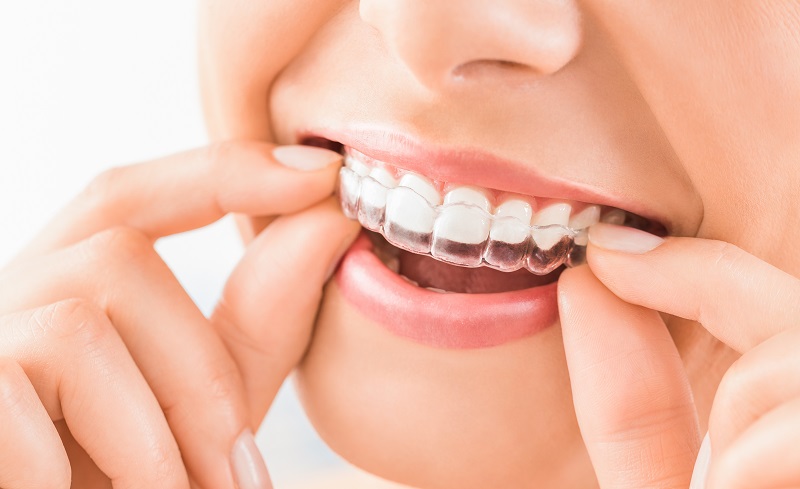 7 Important Care And Maintenance Tips For Your Invisalign Aligners